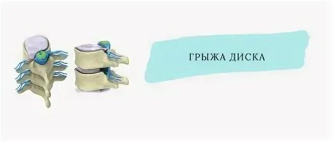 Против грыжи