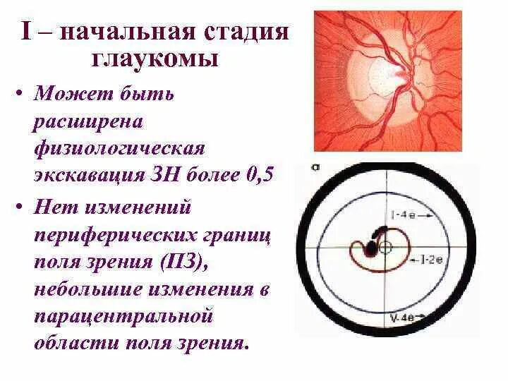 Терминальная глаукома экскавация. Глаукомная экскавация диска зрительного нерва. Экскавация диска зрительного нерва при глаукоме 1 стадии. Физиологическая экскавация зрительного нерва. Классификация глаукомы