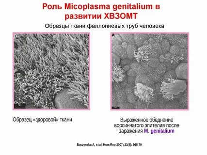 Микоплазмоз у женщин симптомы и причины