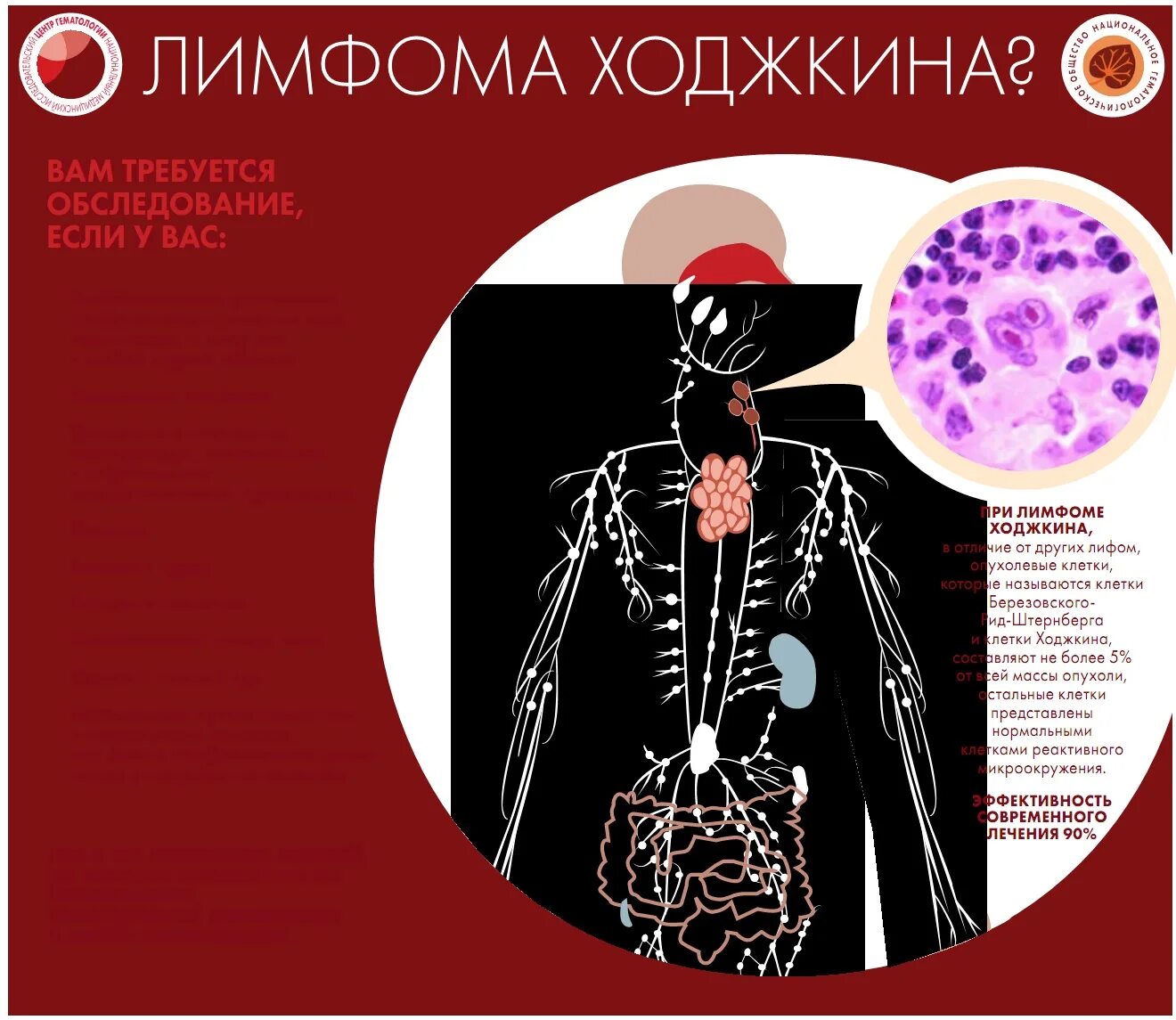 Неходжкинские лимфомы лечение. Неходжкинская лимфома. Лимфома не Ходкинская. Неходжкинские лимфомы клинические рекомендации. Неходжкинская лимфома маргинальной зоны.