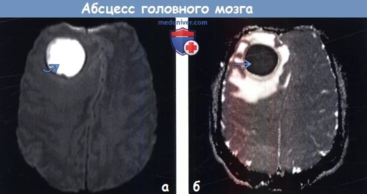 Абсцесс мозга. Абсцесс головного мозга мрт.