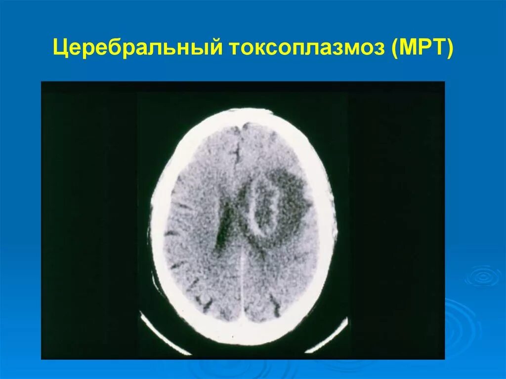 Церебральный токсоплазмоз кт. Церебральный токсоплазмоз кт. Токсоплазмоз головного мозга при вич мрт. Токсоплазмоз на кт головного мозга. Токсоплазмоз кт головы.