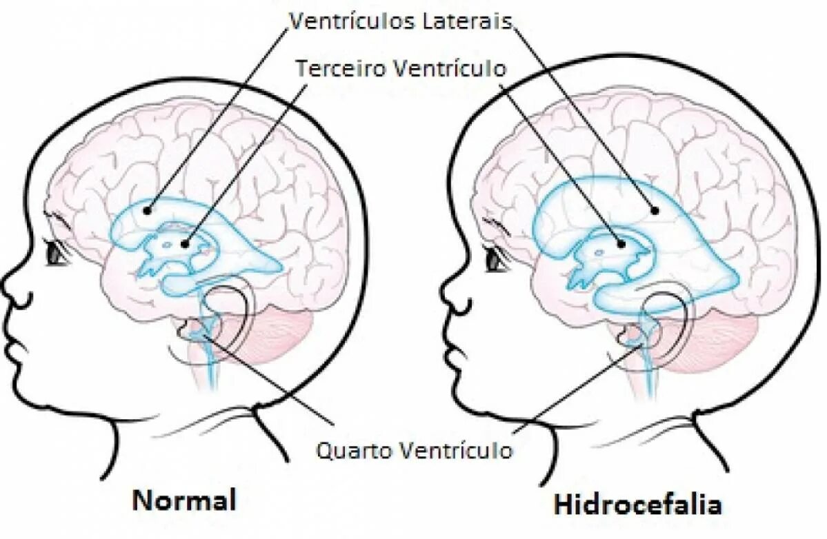 Гидроцефалия шунтирование мозга. Гидроцефалия головного мозга.