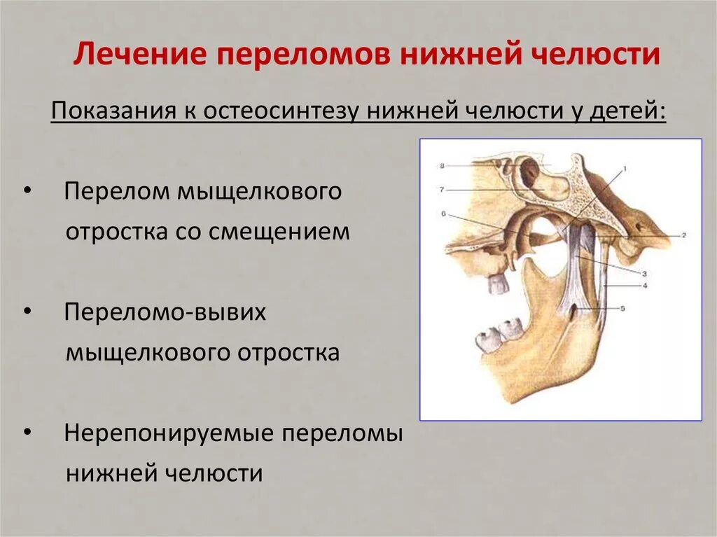 Мыщелок нижней. Перелом мыщелкового отростка нижней челюсти. Остеосинтез суставного отростка нижней челюсти. Перелом мыщелкового отростка нижней челюсти кт. Перелом Нижнего суставного отростка.