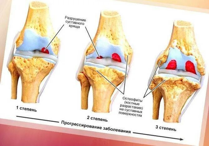 Остеоартроз 1 2 степени коленного сустава. Двусторонний гонартроз, 1ст. Гонартроза 2 степени коленного сустава. Варусный гонартроз коленного сустава. Гонартроз 1-2 степени коленного сустава.