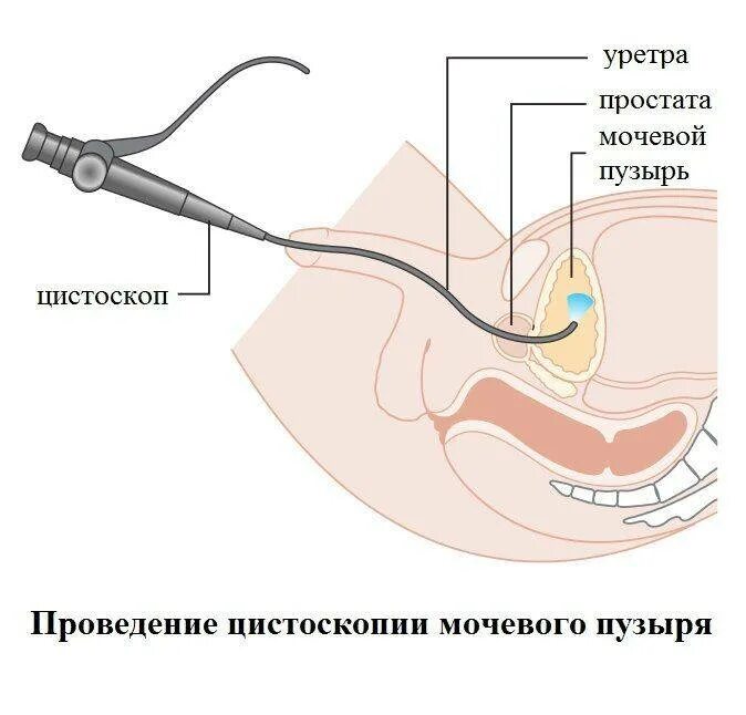 Цистоскопия мочевого пузыря у женщин как делают. Цистоскоп для мочевого пузыря. катетер фолея введение. мочевой катетер для женщин алгоритм. проведение цистоскопии мочевого пузыря у женщин.