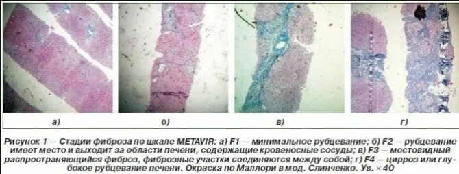 Сколько живут фиброзом 4. Фиброз печени по шкале метавир. Фиброз 2 степени. Гистологические стадии фиброза печени. Фиброз печени f1 по шкале metavir.