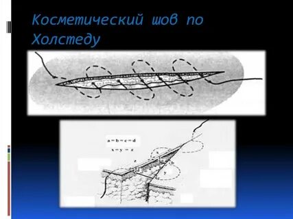 Внутрикожный шов