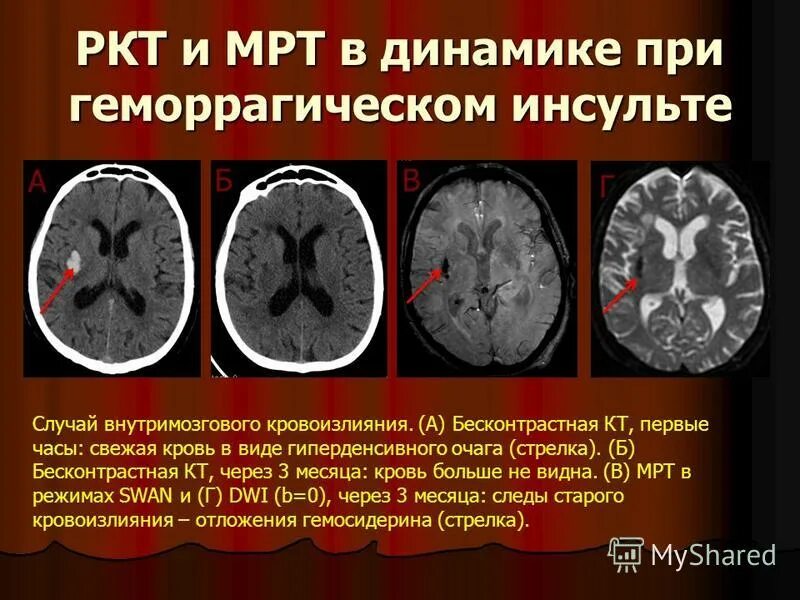 Инсульт правая сторона мозга последствия. Ишемический инсульт кт и мрт. Геморрагический инсульт головного мозга кт. Кт мрт ишемического и геморрагического инсульта. Стадии внутримозгового кровоизлияния на мрт.