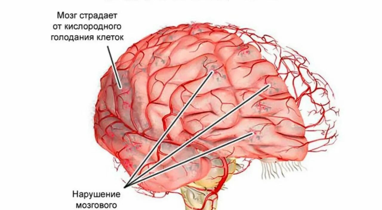 Сосудистые поражения мозга. Сосудистые заболевания центральной нервной системы. Хронические прогрессирующие сосудистые заболевания головного мозга..