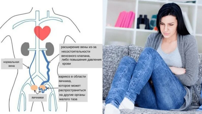 Варикоз малого таза причины. Варикозное расширение вен малого таза. Варикоз расширение вен малого таза. Варикозное расширение вен таза у женщин. Варикозное расширение вен малого таза у женщин.