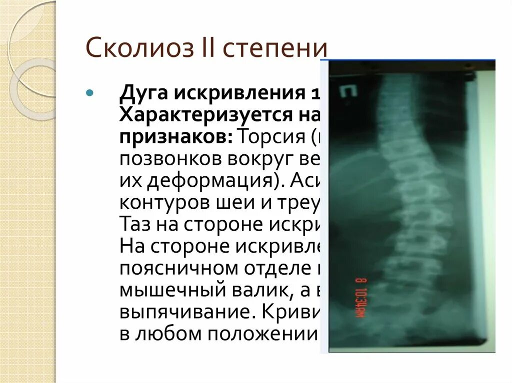 Сколиоз 2 степени это. Торсия позвонков рентген степени. Степени искривления сколиоза. Искривление позвоночника рентген. Сколиоз торсия позвонков.