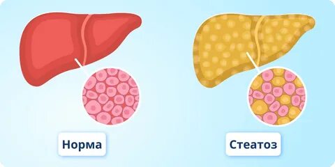 Стеатоз печени симптомы