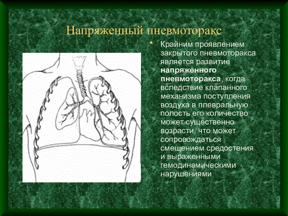 Клапанный пневмоторакс механизм развития. Клапанный пневмоторакс механизм развития. Пневмоторакс разрыв легкого. Легкие напряжены. Легкое человека пневмоторакс.