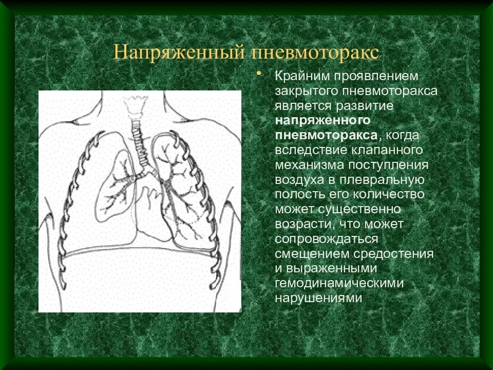 Попадание воздуха в полость. Клапанный пневмоторакс осложнения. Напряженный пневмоторакс. Закрытый напряженный пневмоторакс. Напряженный пневмоторак.