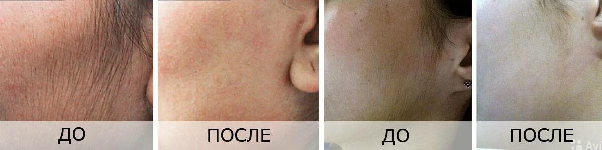 Лазерная эпиляция волосы выпадают через. Лазерная эпиляция лица до и после. лазерная эпиляция лица для женщин. лазер после первой процедуры.