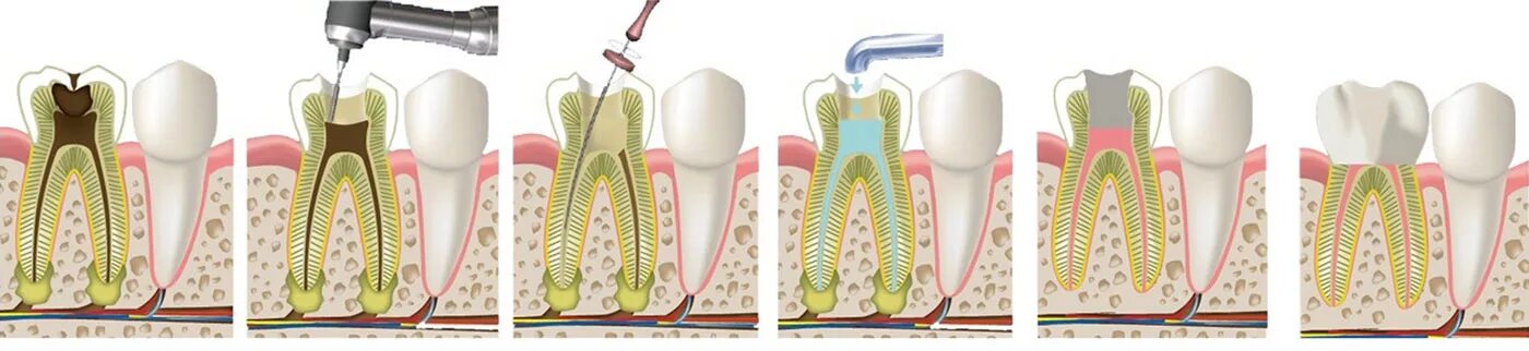 Девитальная экстирпация. Пульпит витальная экстирпация. Трехкорневой периодонтит. Этапы эндодонтического лечения