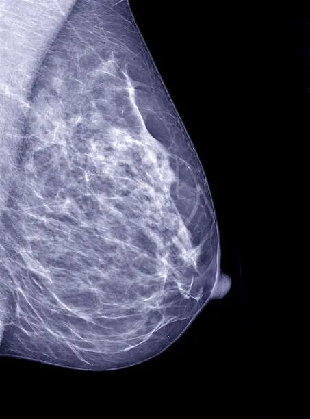 X-ray Picture Mammography. Asymmetry. Tumor. Stock Image - Image of mammary, hos