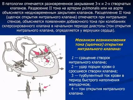 Тон открытия митрального клапана