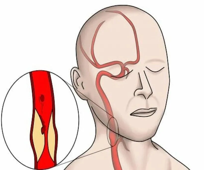Голова болит сбоку. Шейная мигрень симптомы. Сонная артерия мигрень.
