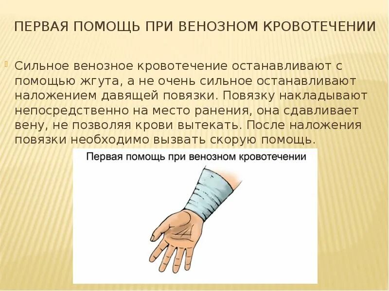 Наложение жгута при венозном кровотечении. Место наложения жгута при венозном кровотечении. Наложение повязки при венозном кровотечении. Остановка венозного кровотечения.