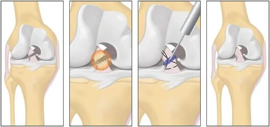 ПКС (передняя крестообразная связка). Артроскопическая резекция мениска. Аутопластика ПКС коленного сустава. Разрыв ПКС коленного сустава операция. Операция колено пкс