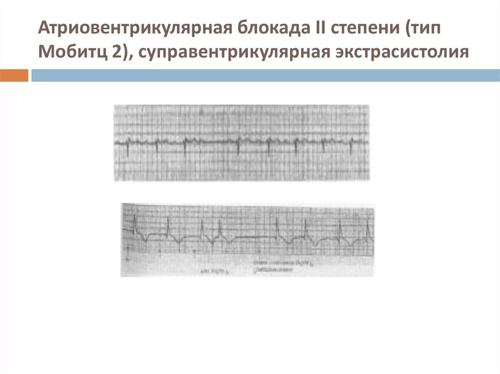 Для атриовентрикулярной блокады II степени Тип Мобитц II. Атриовентрикулярная экстрасистолия на ЭКГ. АВ блокада 2 степени предсердная экстрасистолия. Блокированная предсердная экстрасистолия на ЭКГ. Блокада экстрасистолы