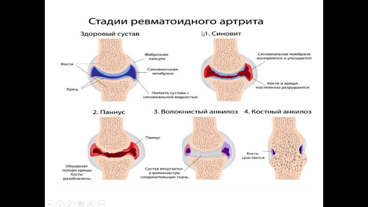 Pannus ревматоидный артрит. Стадии ревматоидного артрита паннус. Стадии и морфология ревматоидного артрита. Синовит ревматоидный артрит. Ранняя стадия ревматоидного артрита