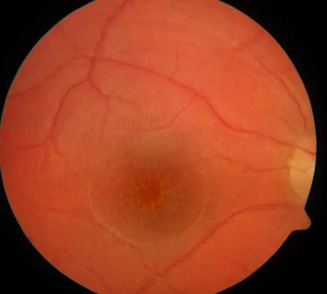 Montagen retinal platina. Диабетическая ретинопатия глаз. Ламеллярный макулярный разрыв. Нормальная картина глазного дна. Кавернозная гемангиома сетчатки глаза.