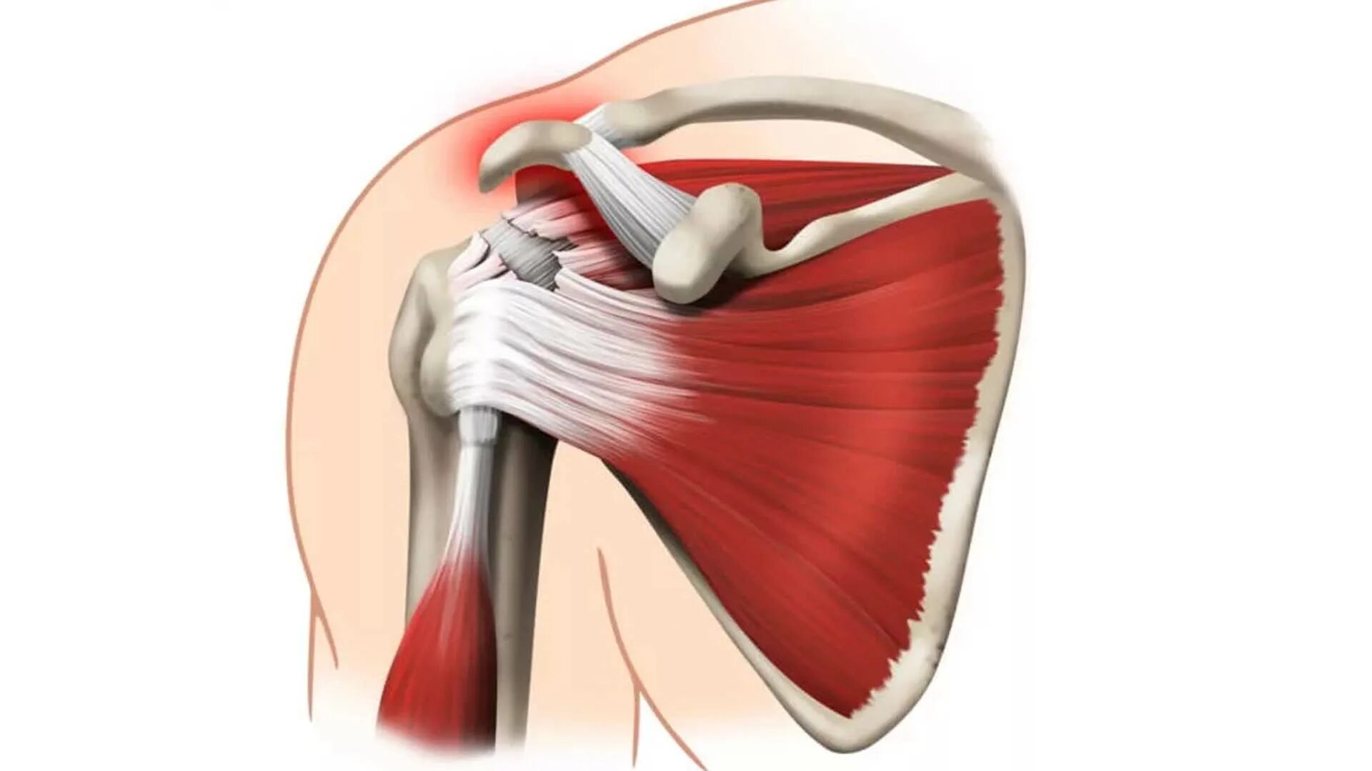 Стучит плечо. Травма ротаторной манжеты плеча. Тендинит мышцы плечевого сустава. Ротаторная манжета плеча анатомия. Тендинит сухожилия надостной мышцы.