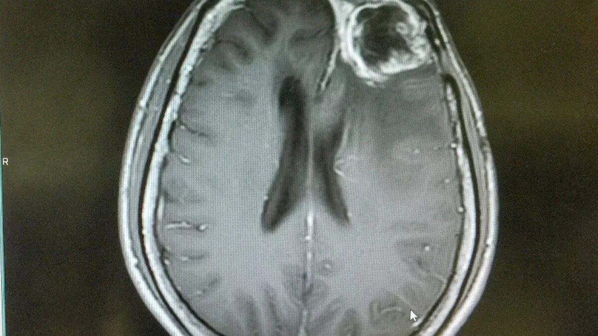 Опухоль мозга глиобластома. Глиобластома головного мозга люди. Онкология глиобластома. Злокачественная глиобластома головного мозга снимок. Опухоль глиобластома