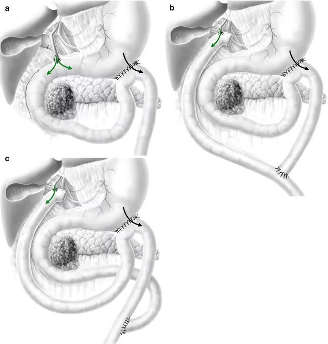 Формирование гастроеюноанастомоза. Гастроеюноанастомоз через сальниковую сумку. Анастомозит что это