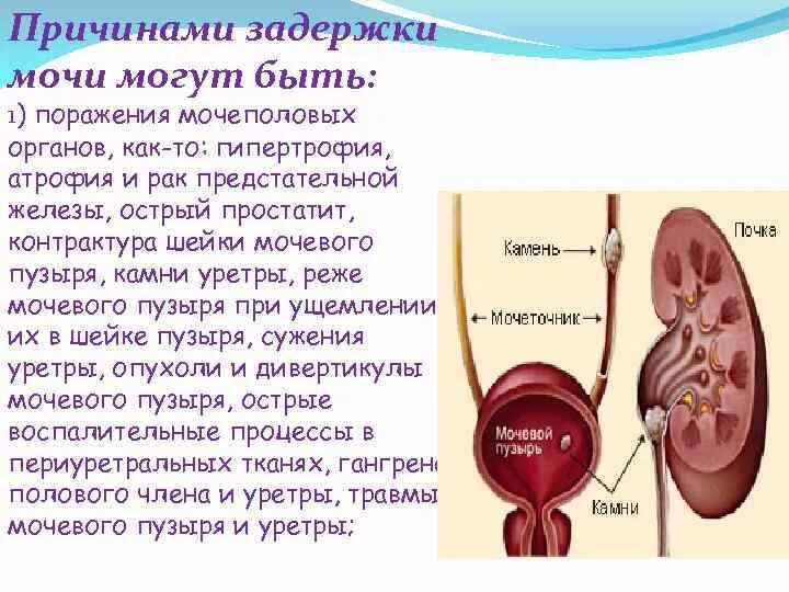 Острые заболевания мочевыделительной системы. Болезни органов мочевыделения. Задержка мочи заболевания мочеполовой системы. Хирургические патологии мочевыделительной системы.