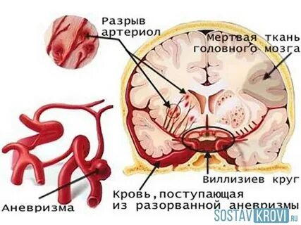 Аневризма головного последствия