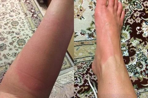 Аллергия снятие отека