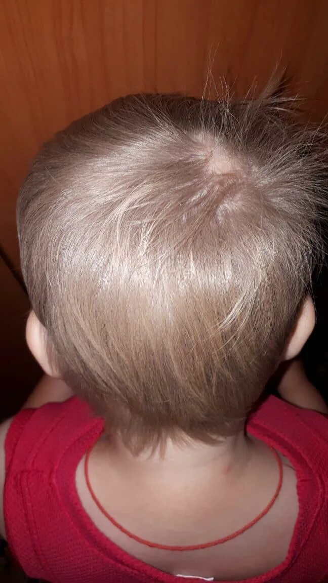 гнёздная алопеция у детей. очаговая (гнездная) алопеция. гнездовая алопеция у детей. гнездовая алопеция у детей. экозависимая алопеция.