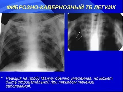 Очаговый туберкулез мокрота