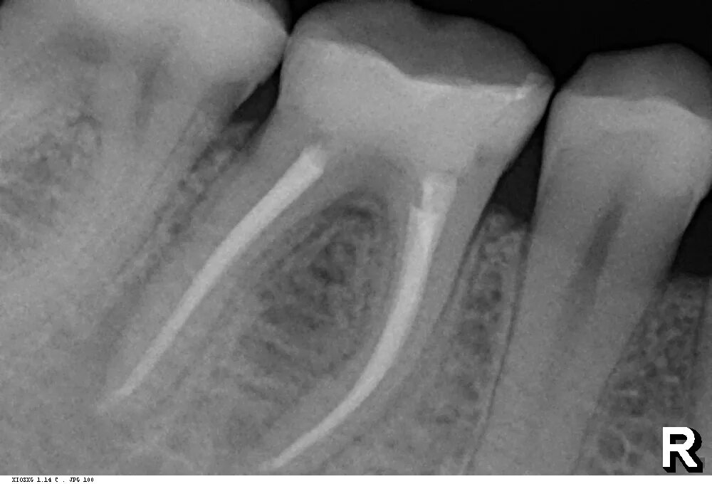 пломбировка каналов зуба снимок. не до конца запломбирован канал зуба. запломбированный канал зуба. запломбировать новостей одолжить. запломбировать новостей одолжить.