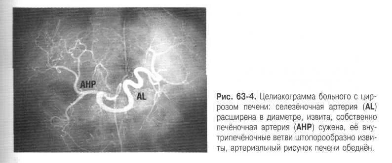 Селезеночная Вена норма на кт. Печеночная артерия на УЗИ. Ангиография воротной вены печени. Расширение селезеночной вены