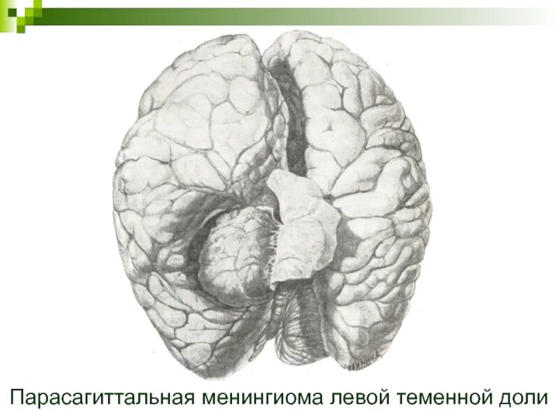 Опухоли теменной. Менингиома лобной доли кт. Парасагиттальная опухоль. Менингиома парасагиттальная лобной доли. Парасагиттальных отделов мозга.