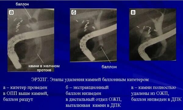 Удаление камня через проток. ЭРХПГ камни в желчном протоке. Конкремент общего желчного протока.