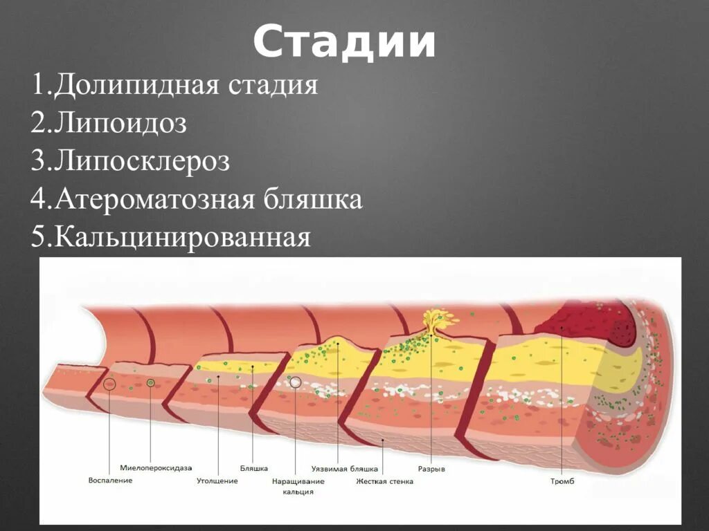 Долипидная стадия атеросклероза. Липоидоз стадия атеросклероза.