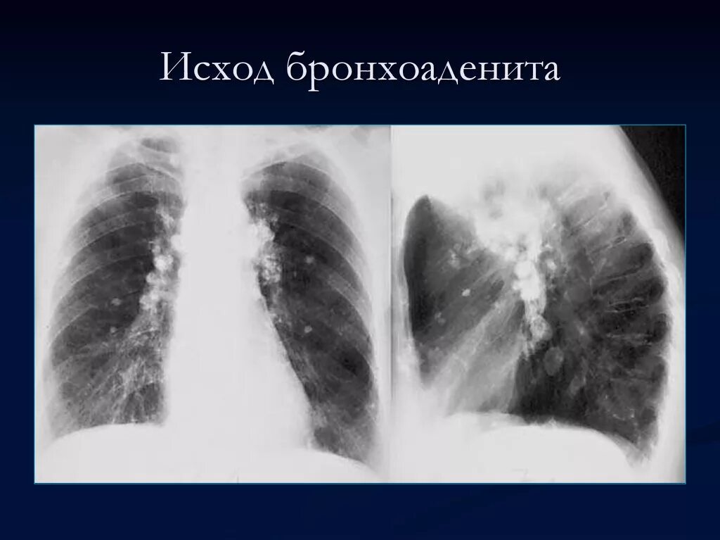 Бронхоаденит это. Инфильтративный бронхоаденит. туберкулез внутригрудных лимфатических узлов рентген. туберкулезный бронхоаденит кт. туберкулезный бронхоаденит рентген.