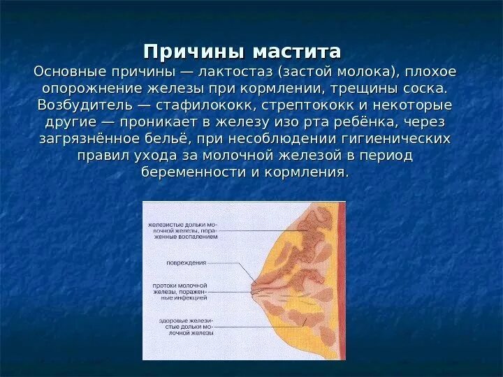 Что такое лактостаз. Симптомы лактационного мастита. лактостаз молочной железы. застой молока в грудных железах.