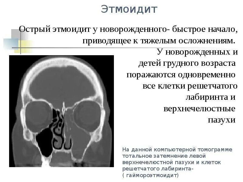 Хронический гайморит этмоидит фронтит. Этмоидит (воспаление решетчатой пазухи). Острый этмоидальный синусит симптомы. Утолщение слизистой оболочки решетчатых лабиринтов