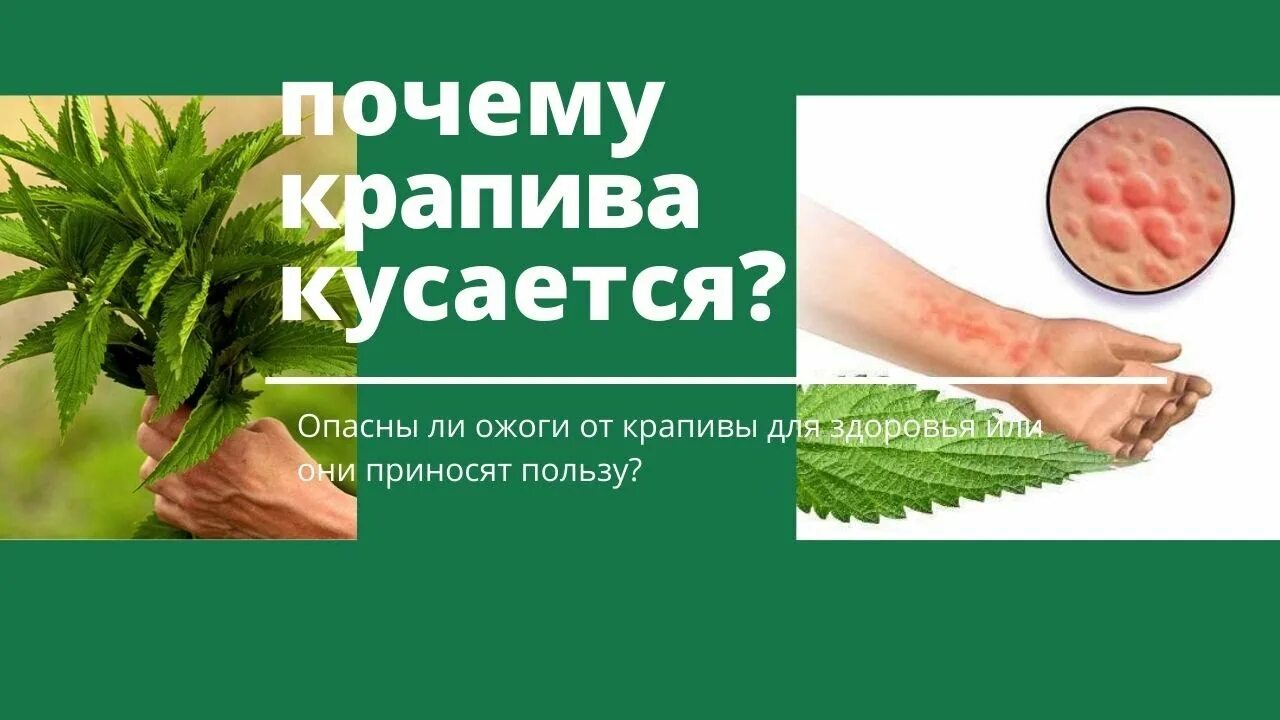 Почему крапива кусается? Опасны ли ожоги от крапивы для здоровья или они принося