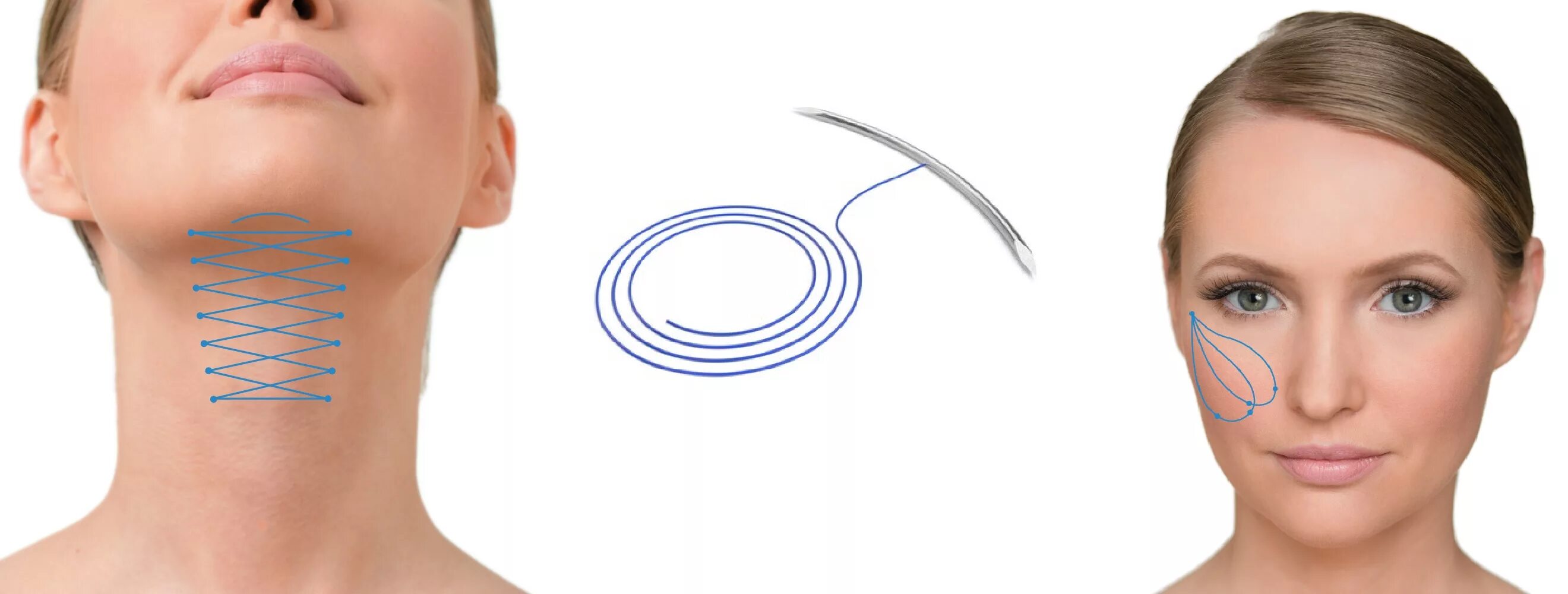 Нити aptos needle blunt. Подтяжка шеи нитями аптос. Аптос шея. Аптос light lift needle 2g. Aptos excellence visage нитевой лифтинг.