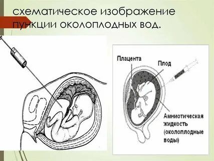 Кто делал амниоцентез форум