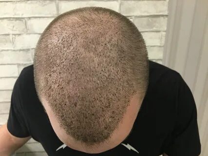 10 дней после пересадки