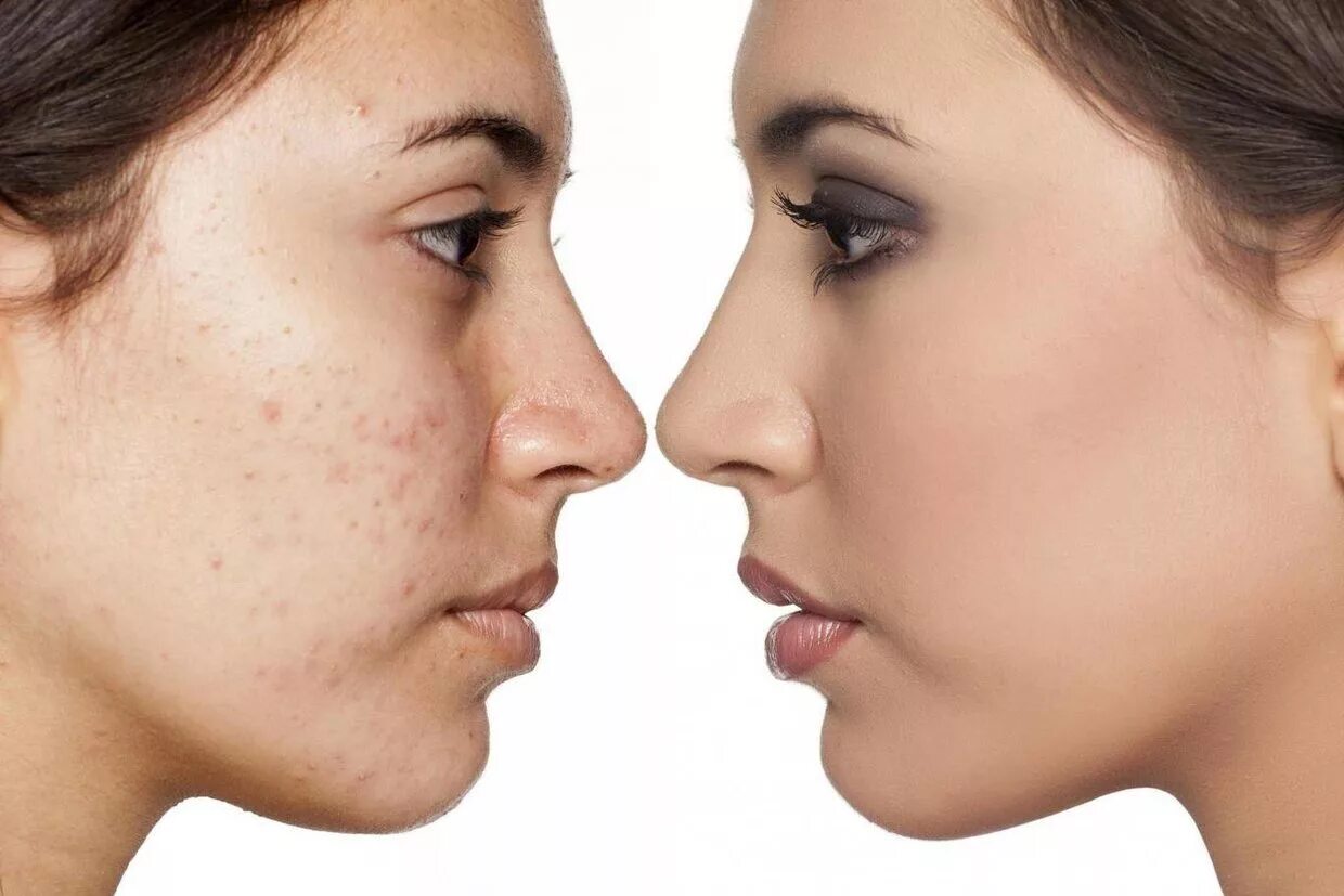 девушка с проблемной кожей. лицо девушки. акне (угревая болезнь, прыщи). лечение кожи акне. лечение кожи акне.